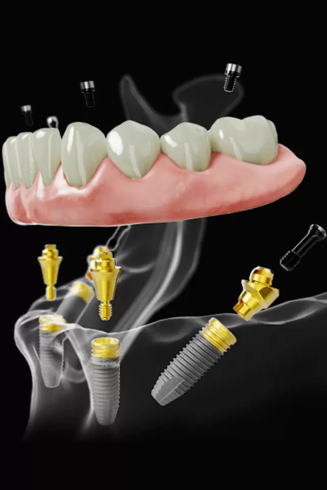 Dental Implant Clinic