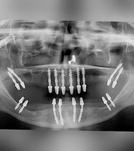 Basal Implants at FMS Hyderabad