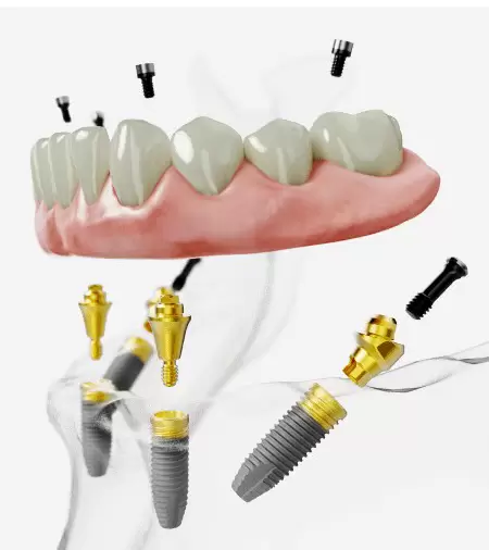  All-on-4 Dental Implants