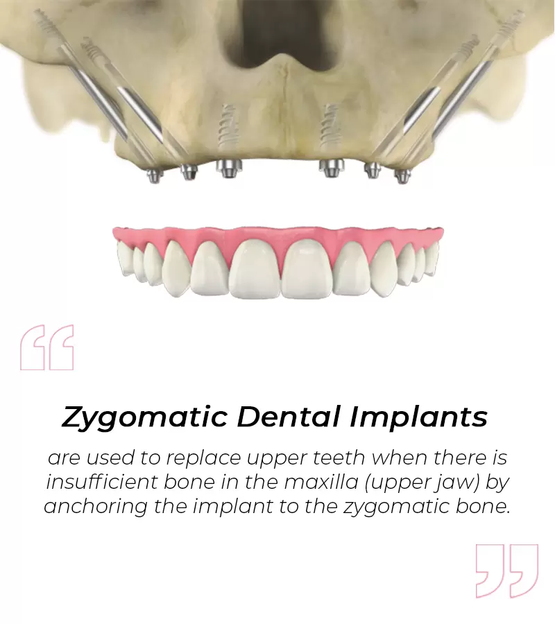Zygomatic Dental Implants India