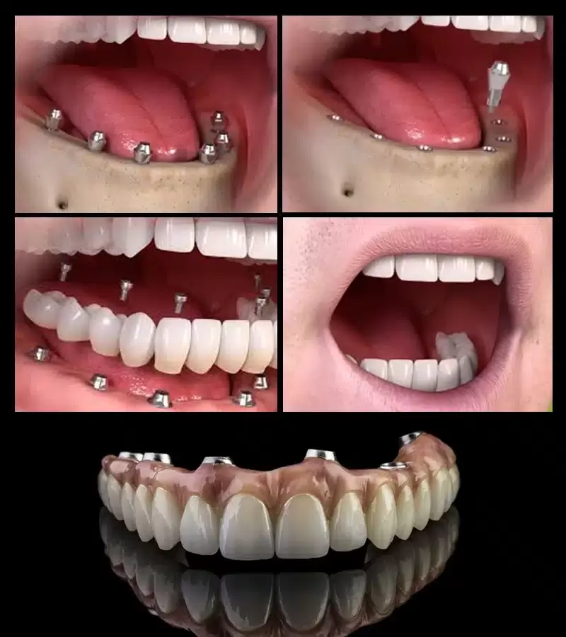 All-on-6/8 Dental Implants Hyderabad