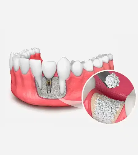 Bone Grafting & Sinus Lift — When Additional Procedures Are Needed