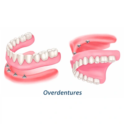 Implant-Supported Dentures — Hyderabad