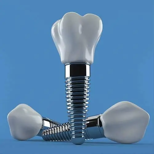 Single Tooth Dental Implant — Hyderabad