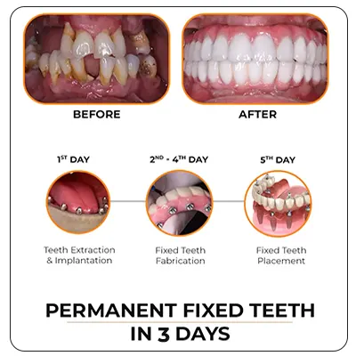 Immediate Loading Implants — Same-Day Teeth