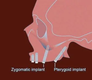 Pterygoid Dental Implants Hyderabad